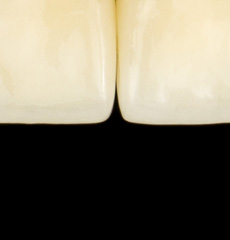 Zirconium versus e.max Press