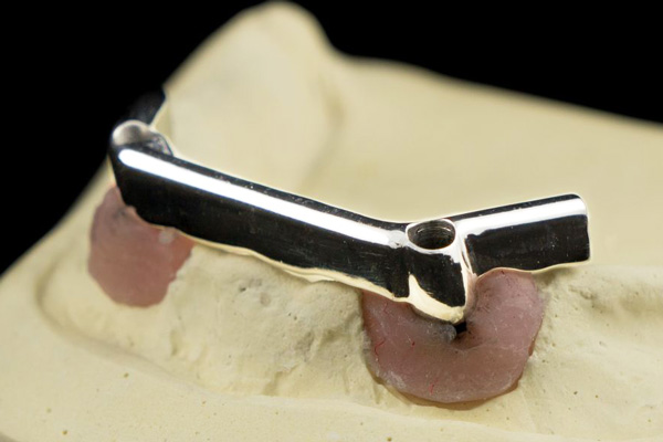 Implant Bar